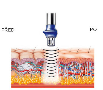 Celulitidová terapie – rázová vlna a lymfodrenáž