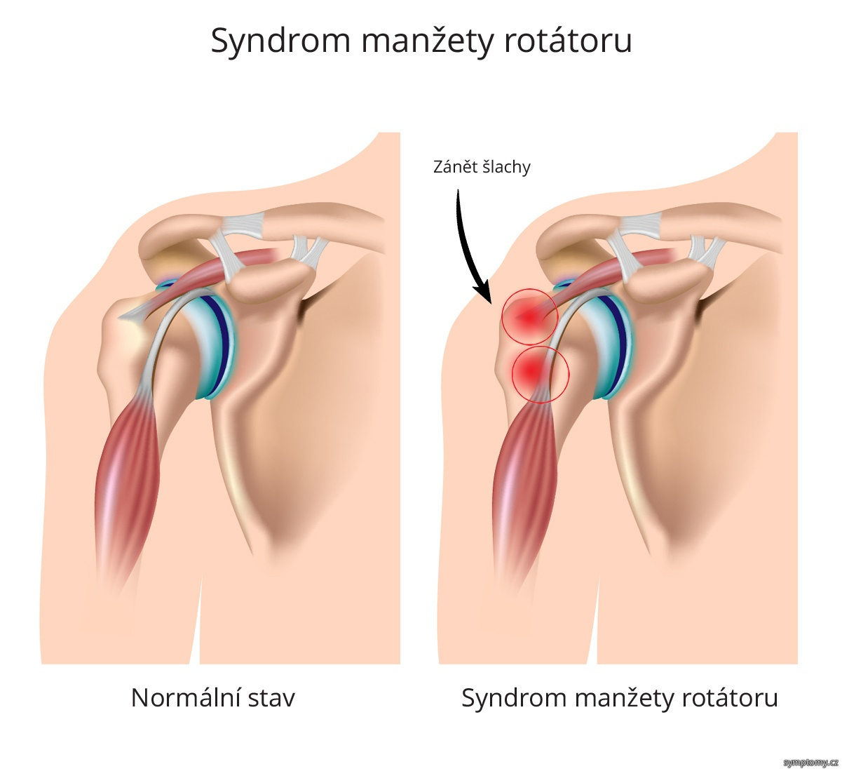 Bolest ramene anatomie ramenního kloubu